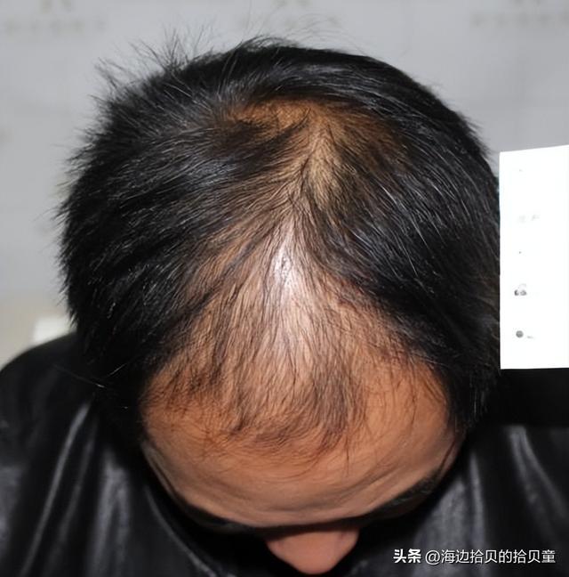 子最好？育发液什么牌子最有效果？冰球突破正规网站日本生发液哪个牌(图3)
